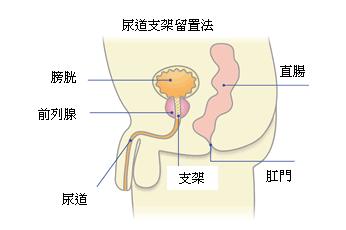 尿道支架留置法