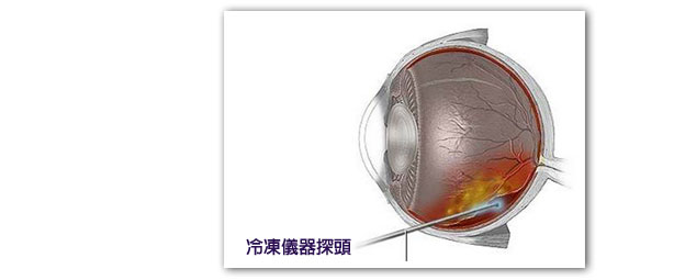 冷凝裂孔封閉手術探頭