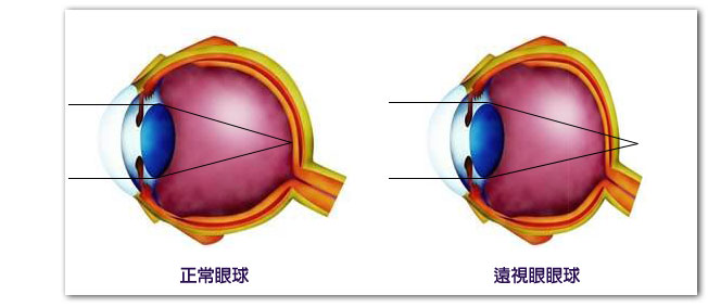 遠視眼球