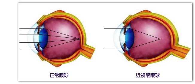 近視眼球