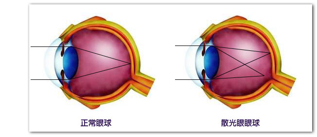 散光眼球