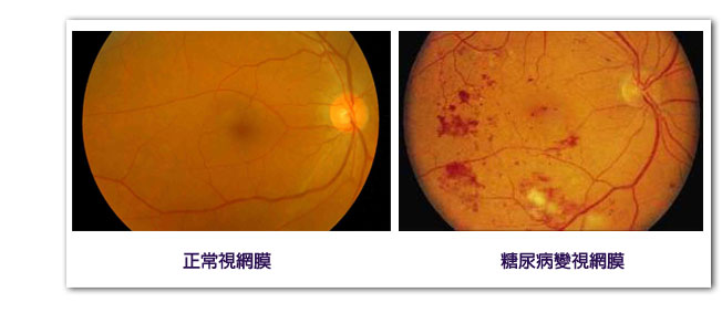 糖尿病視網膜病變