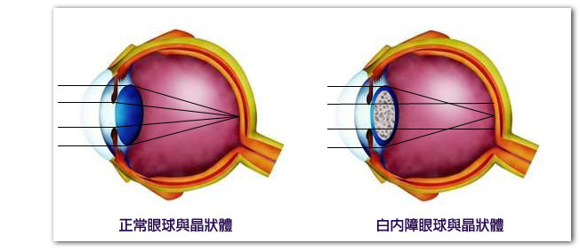 白內障眼球