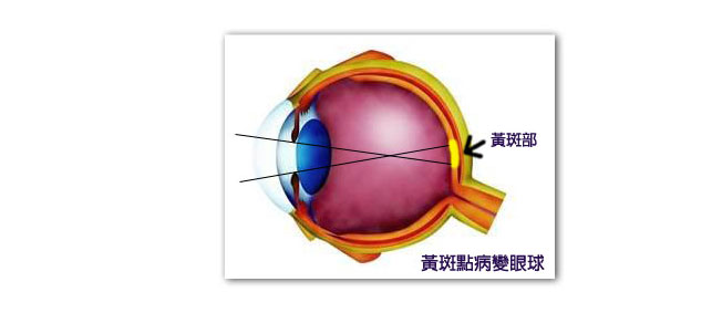 黃斑點病變眼球