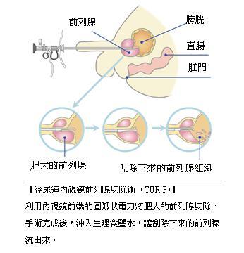 經尿道內視鏡前列腺切除術