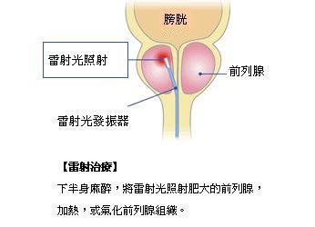 雷射治療